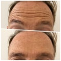 Understanding Forehead Lines and How to Treat Them