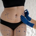 Types of Tummy Tucks: A Comprehensive Guide to Aesthetic Body Contouring