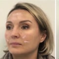 Understanding Nasolabial Folds: A Guide to Facial Rejuvenation