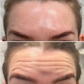 How Long Do Results Last from Botox Injections and Dermal Fillers?