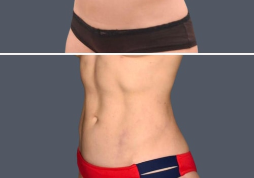 Traditional vs. Modern Liposuction Techniques: A Comprehensive Comparison