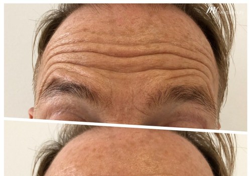 Understanding Forehead Lines and How to Treat Them