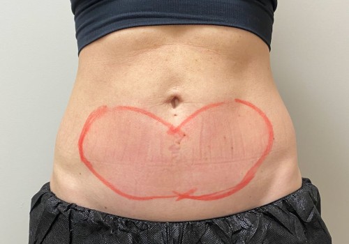 Aesthetic Body Contouring: All You Need to Know About CoolSculpting