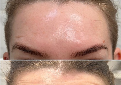 How Long Do Results Last from Botox Injections and Dermal Fillers?